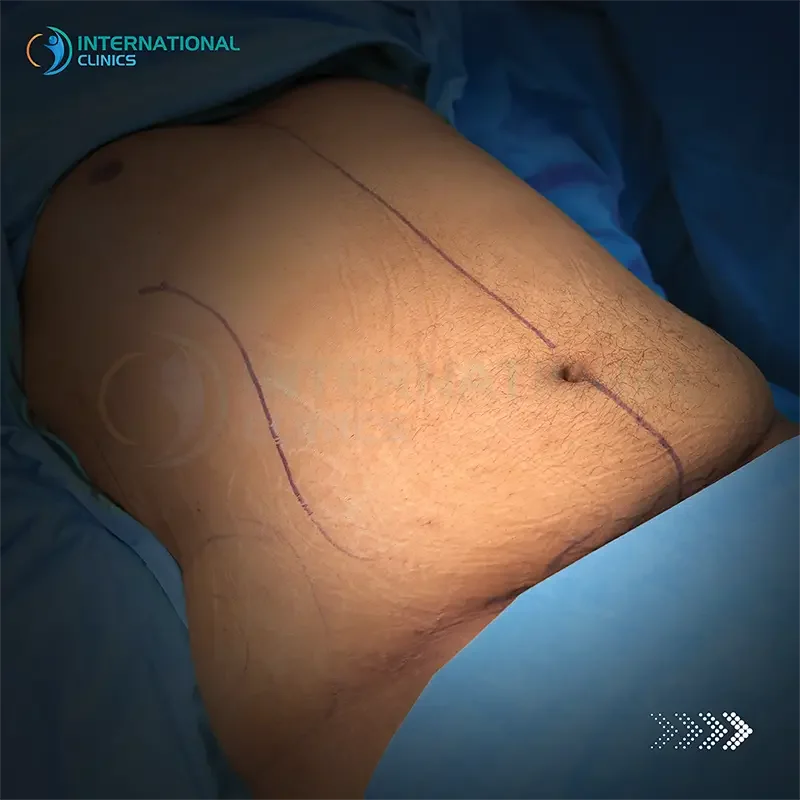 tummy tuck before after in turkey