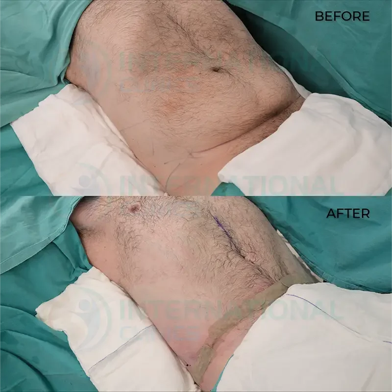tummy tuck before after in turkey