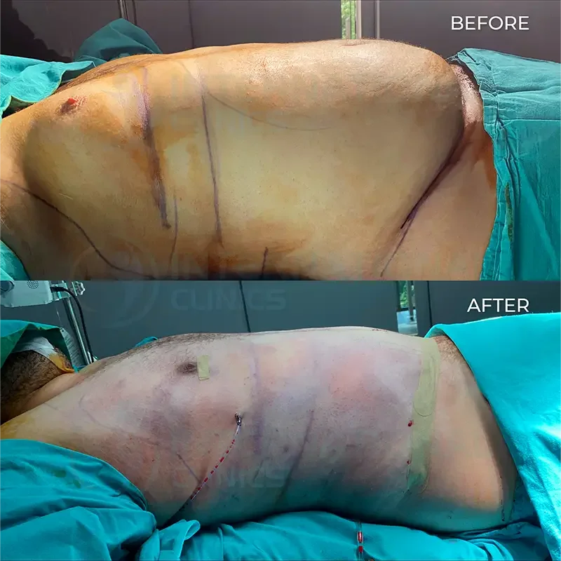 tummy tuck before after in turkey