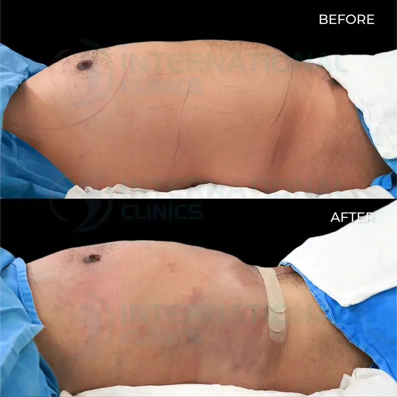 tummy tuck before after in turkey