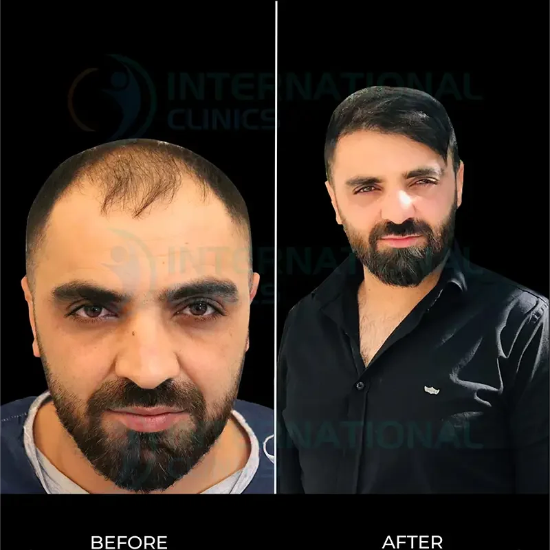 زراعة الشعر قبل وبعد  بالصور في تركيا