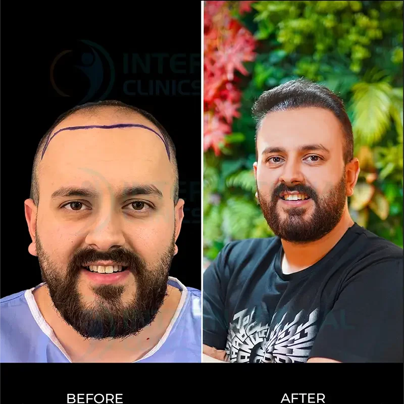 زراعة الشعر قبل وبعد  بالصور في تركيا صورة 5