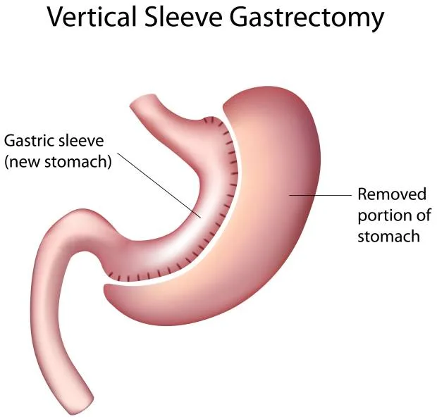 Fistules après une sleeve