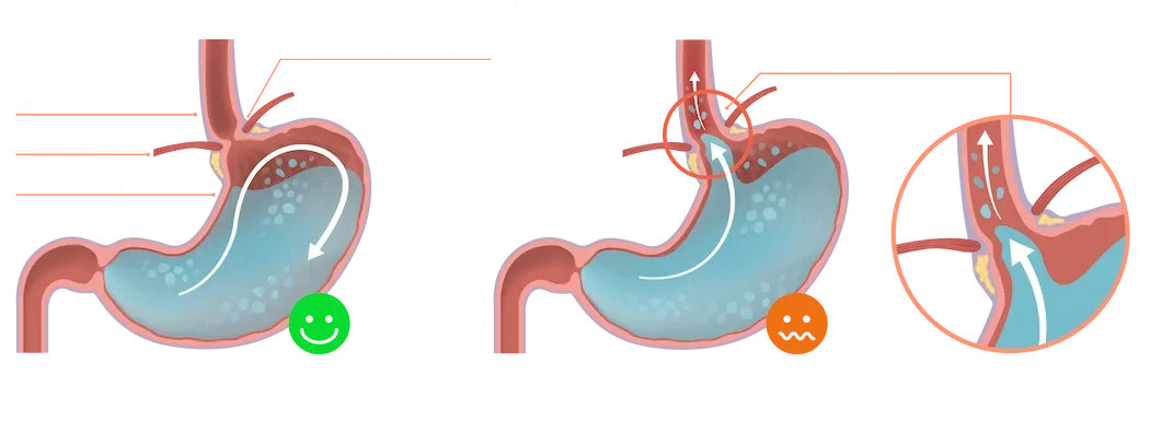 reflux gastro-œsophagien post sleeve