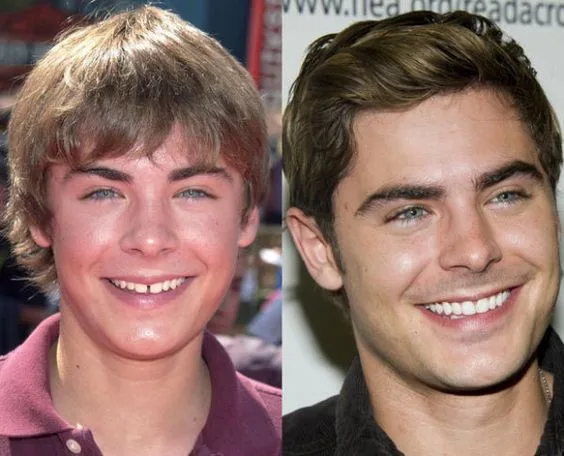 Zac Efron  celebrity dental implant