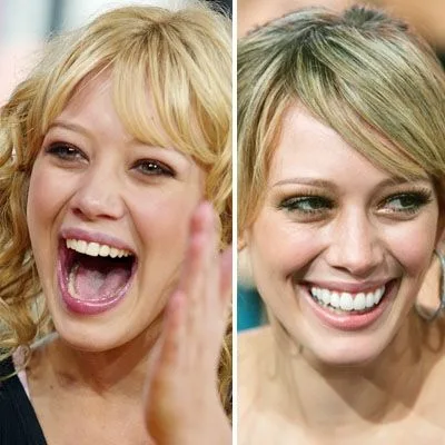 Hilary Duff  celebrity dental implant