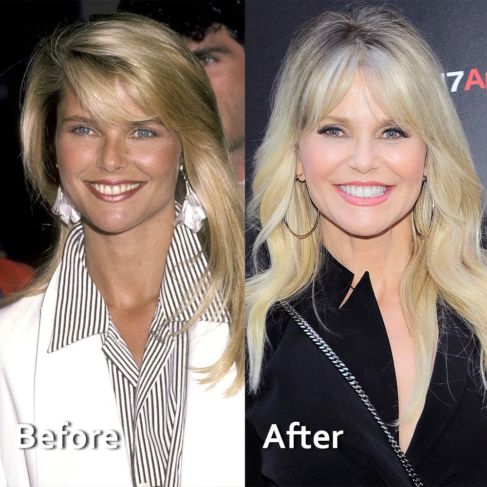 Christie Brinkley  celebrity dental implant