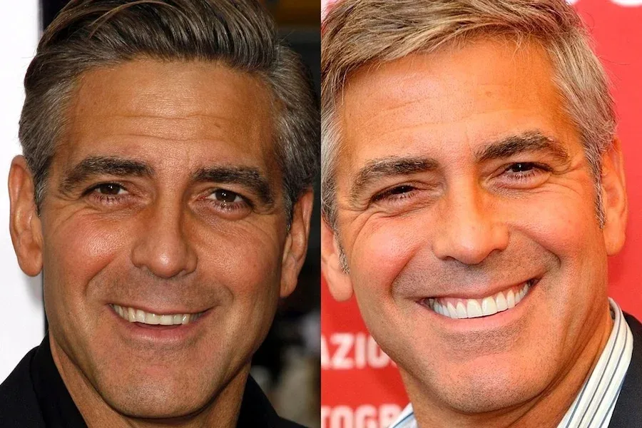 George Clooney  celebrity dental implant