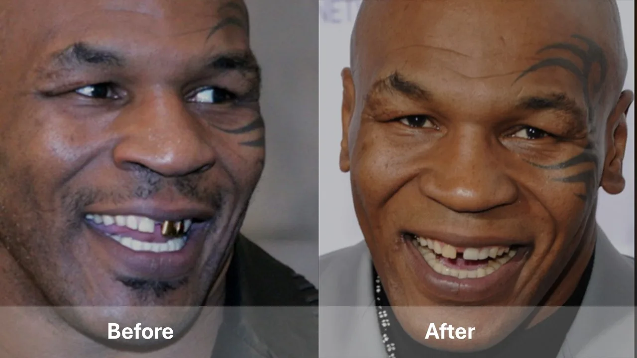 Mike Tyson  celebrity dental implant