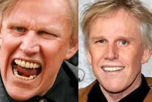Gary Busey celebrity dental implant