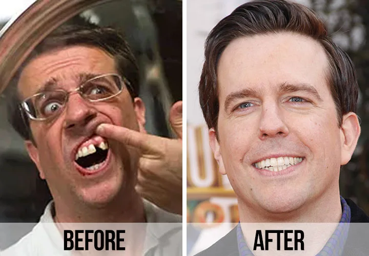 Ed Helms  celebrity dental implant