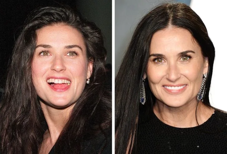 Demi Moore celebrity dental implant