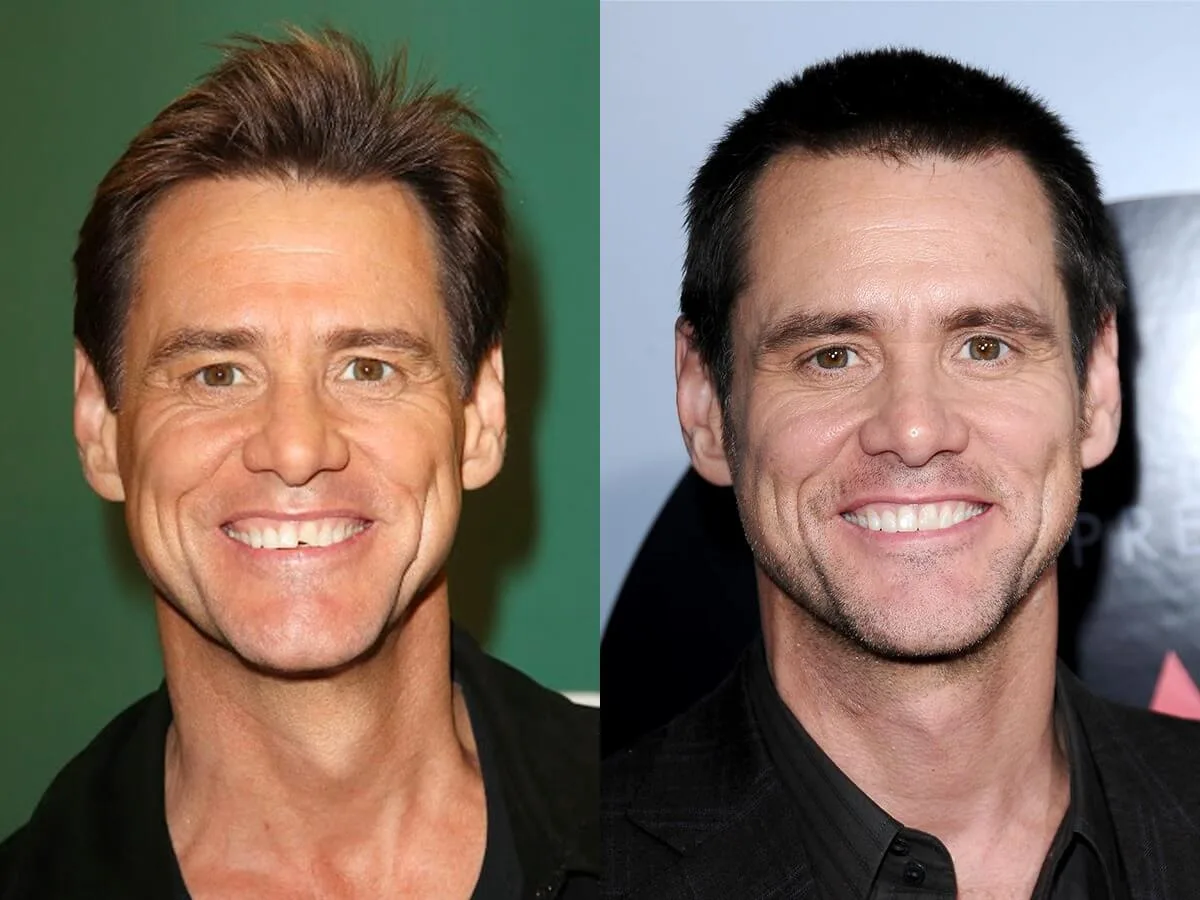 Jim Carrey  celebrity dental implant