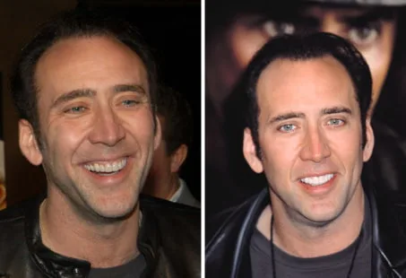 Nicolas Cage  celebrity dental implant
