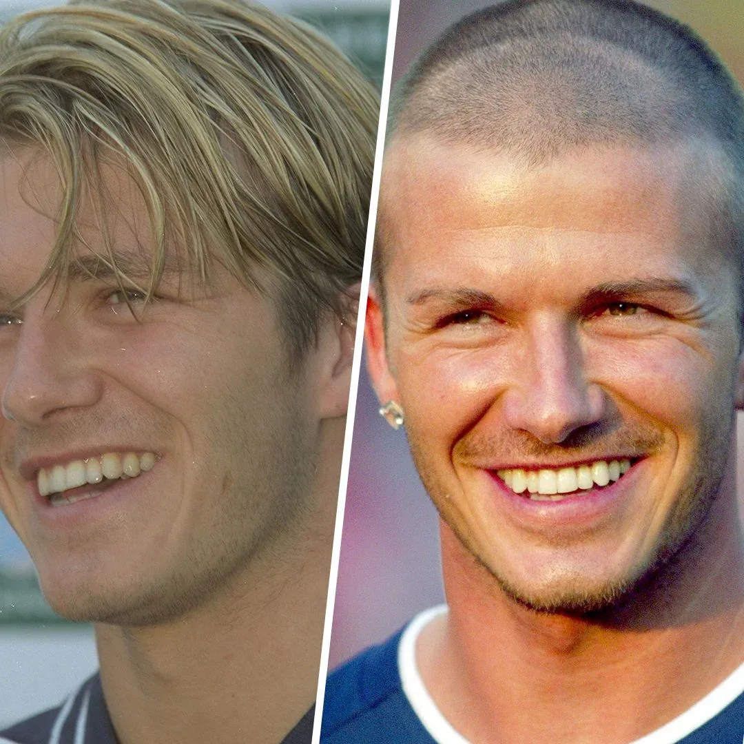 David Beckham  celebrity dental implant