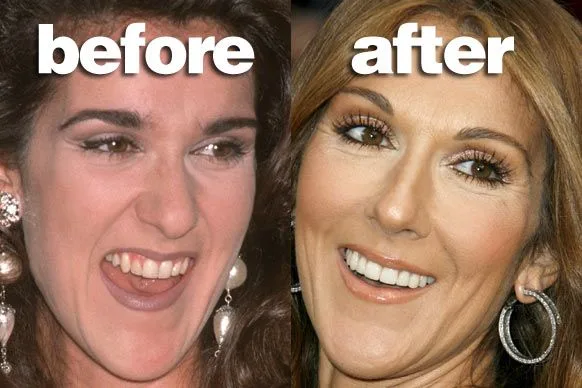 Celine Dion  celebrity dental implant