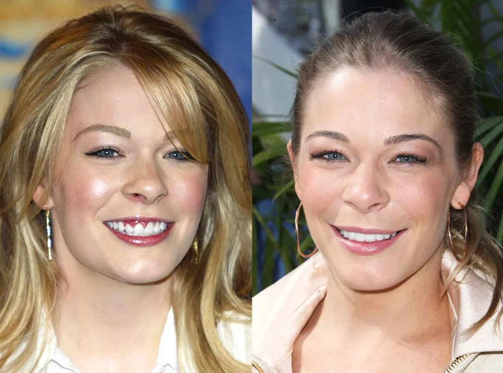 LeAnn Rimes  celebrity dental implant