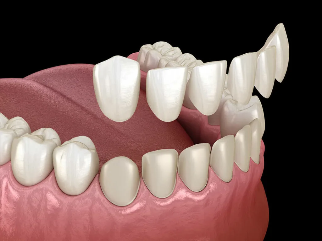 dental veneers are this shells cover the teeth outer surfaces to optimized teeth imperfections