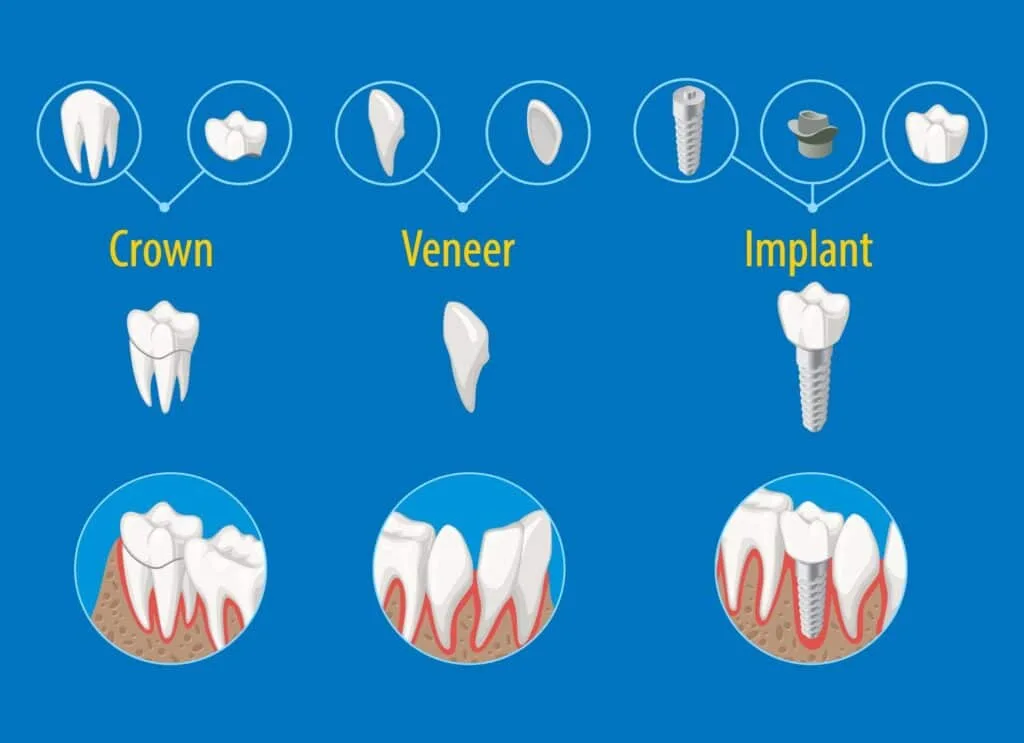 different shapes and structures of dental implant, veneers and crown