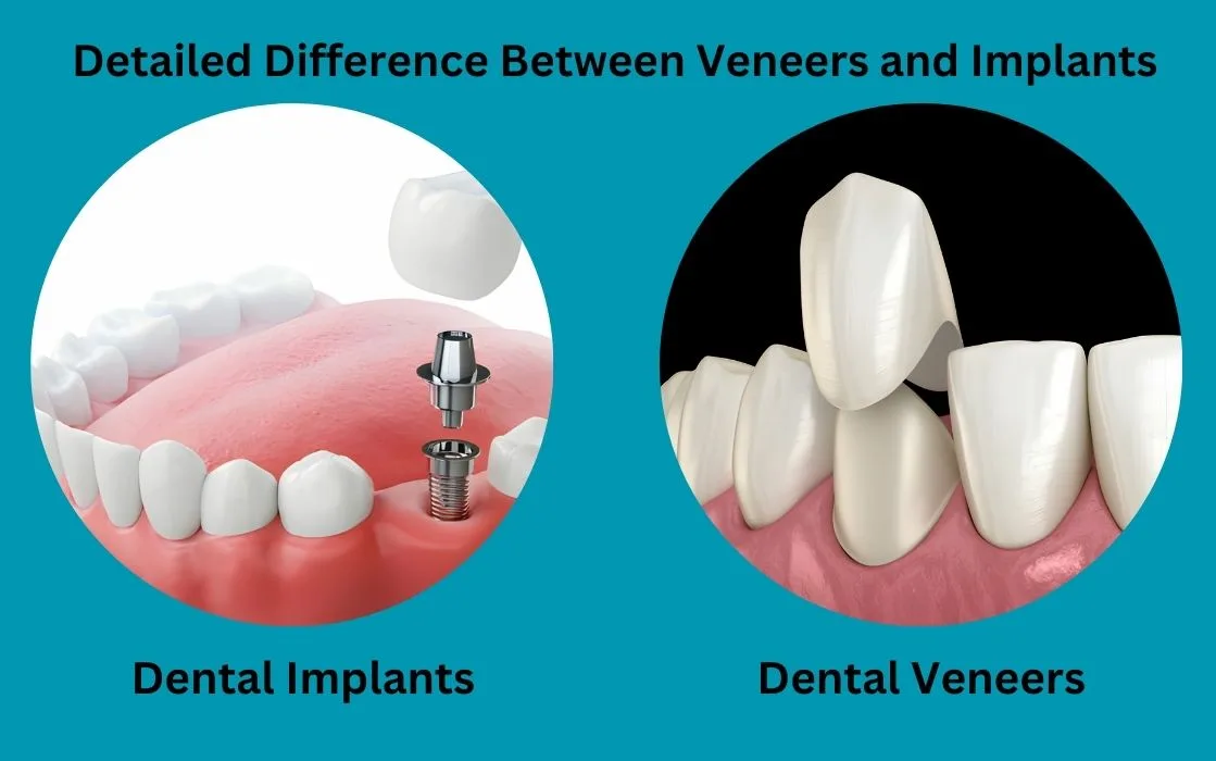 differences between implant and veneers include invasiveness