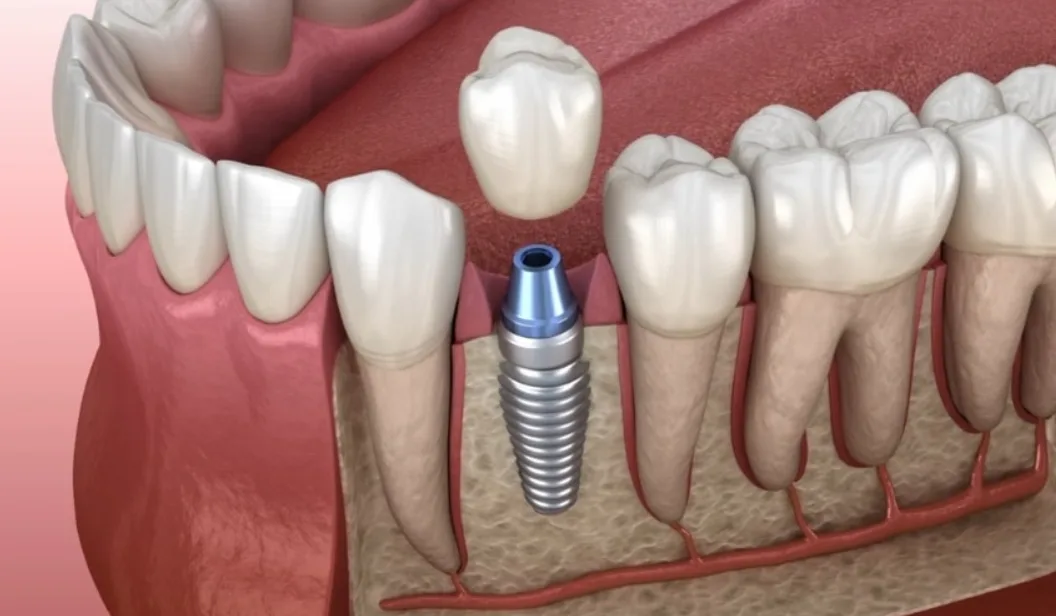 dental implant inserted into jawbone to support the artificial tooth, crown, as missing tooth replacement