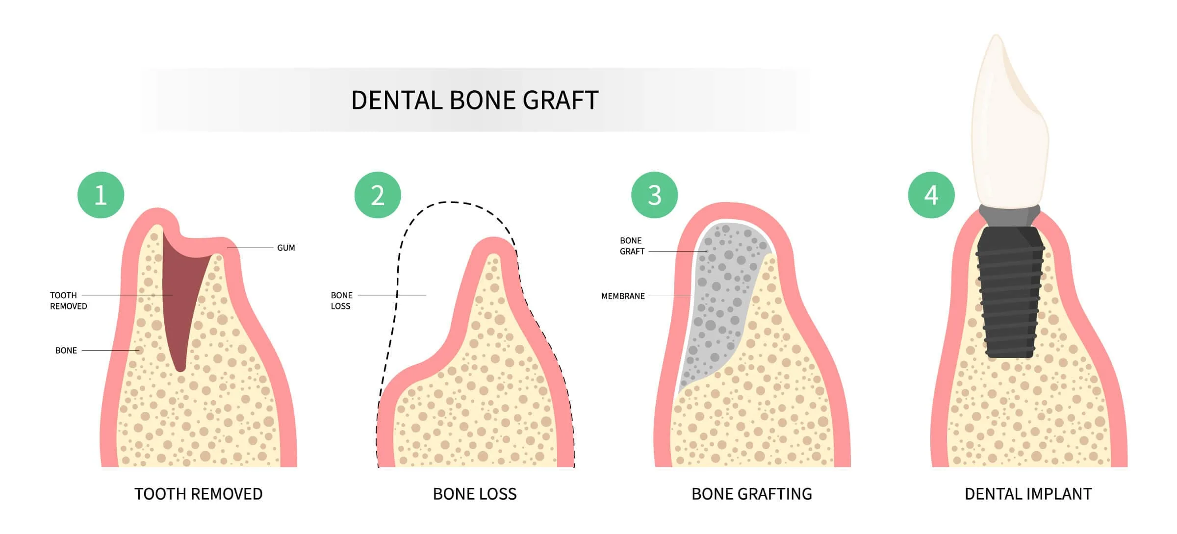 stages of dental implant: tooth extraction, bone grafting, implant insertion and abutment and crown placement