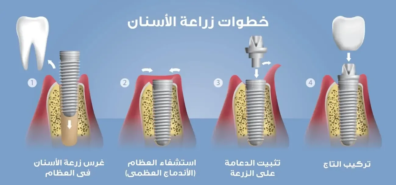 stages of dental implant healing include implant placing, implant integration with bone, abutment and crown placing