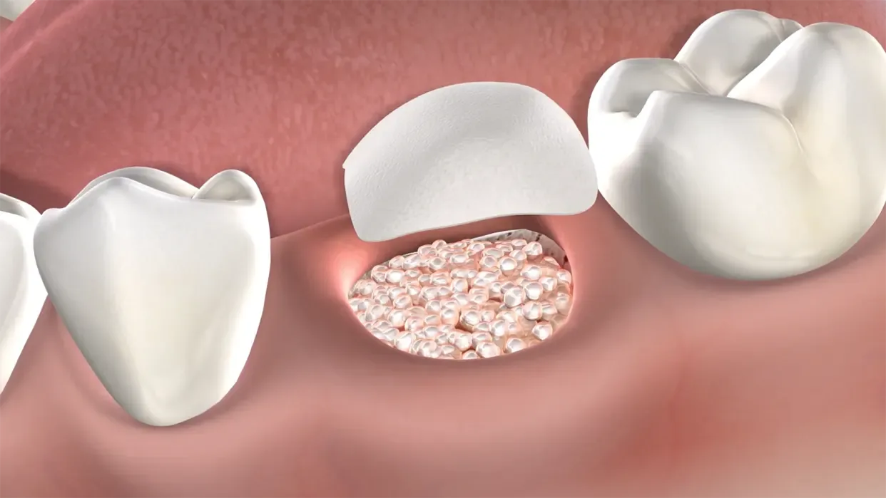 dental bone graft healing includes bone growth, integration and stabilization and remodeling this step is important before dental implant in patients with low dental density