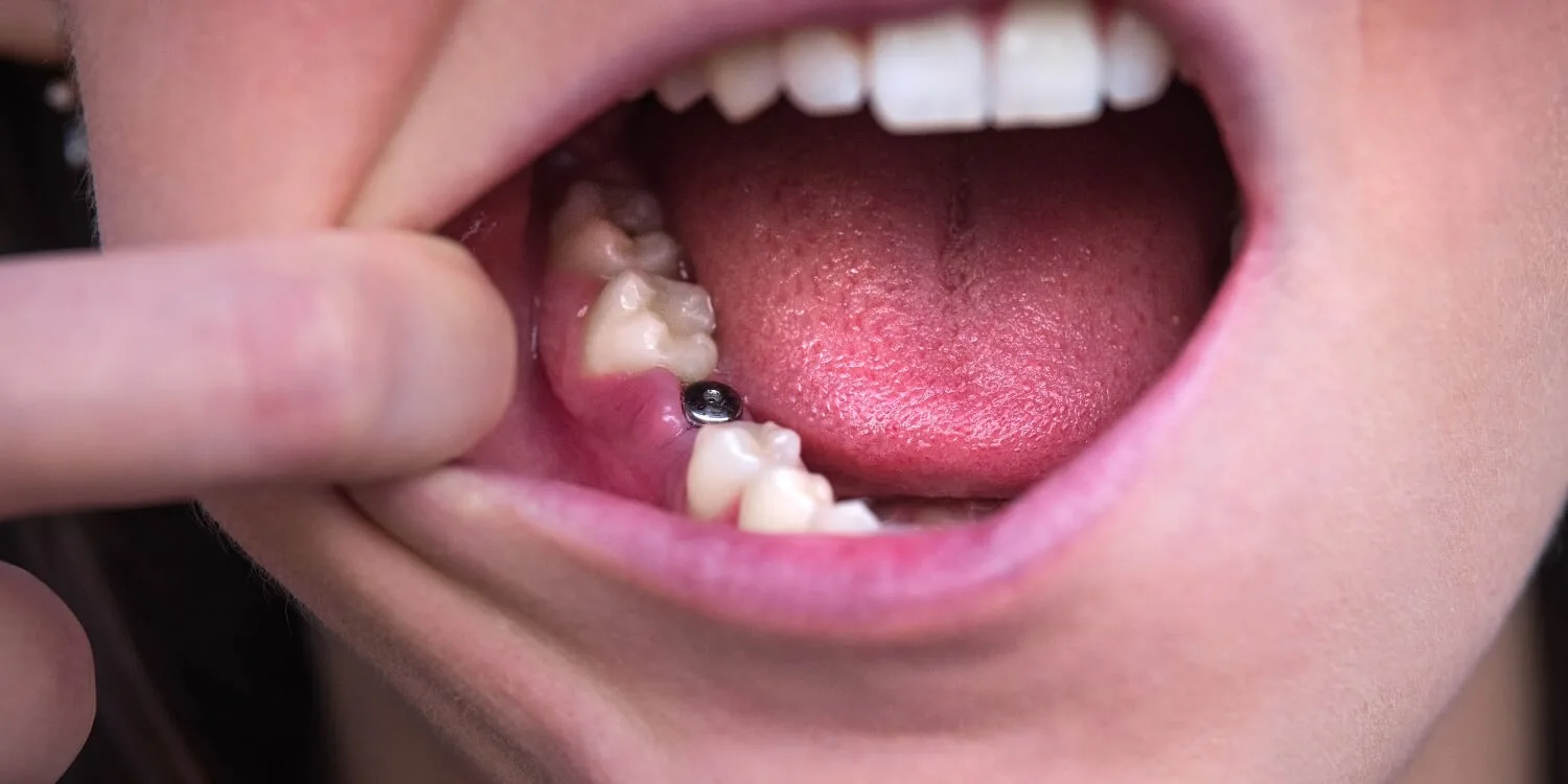 recovery after implant placement