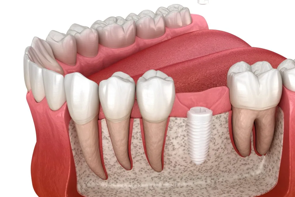 molar dental implant difficalities