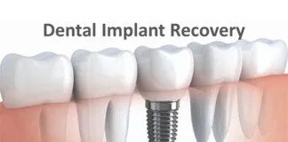 proper healing after dental implant