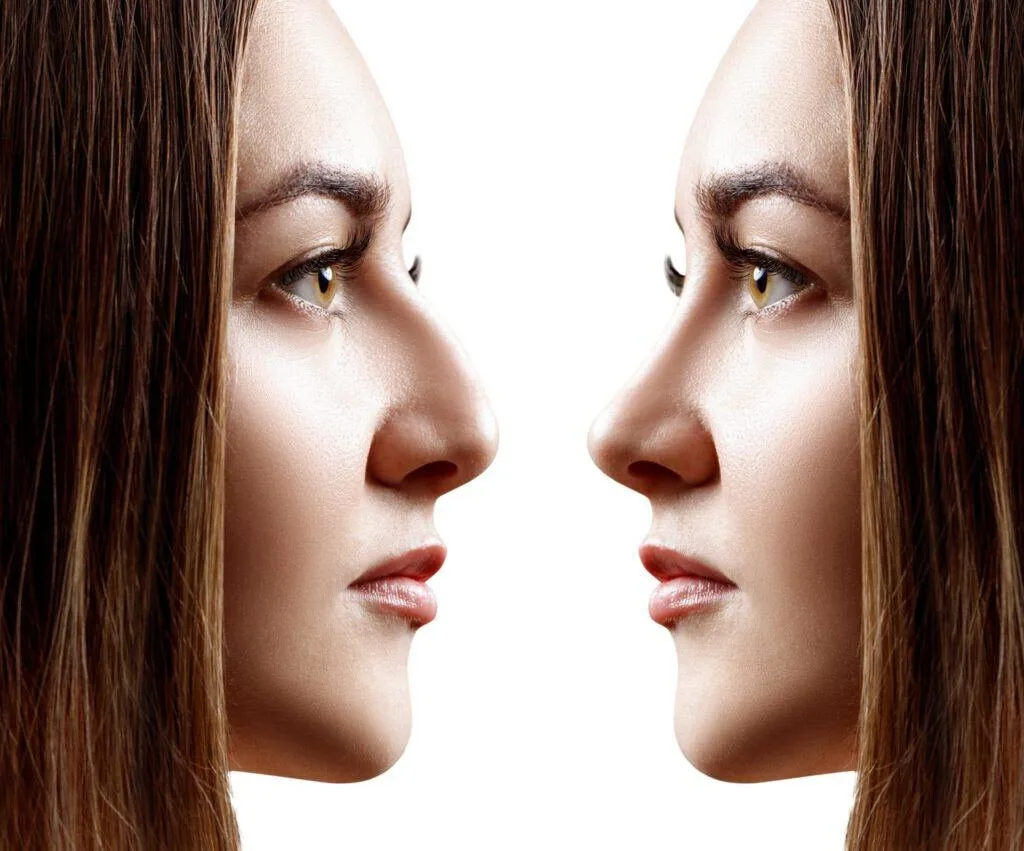 Rhinoplastie avant après