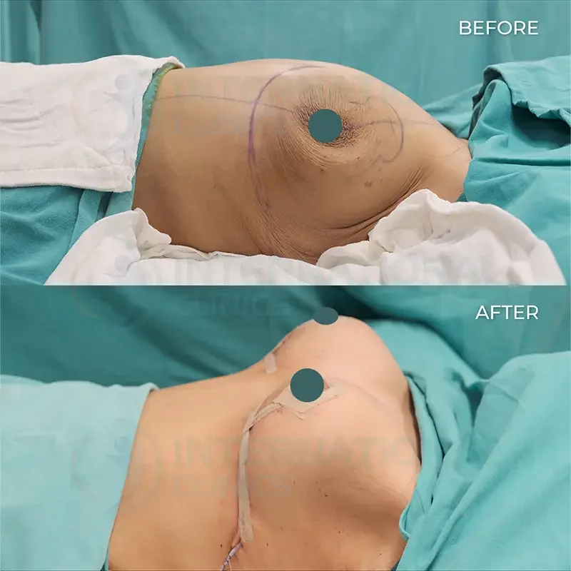 breast lift in turkey before and after
