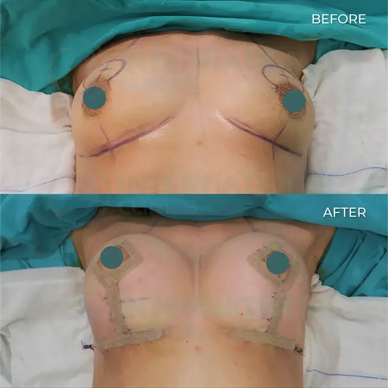 breast lift in turkey before and after1