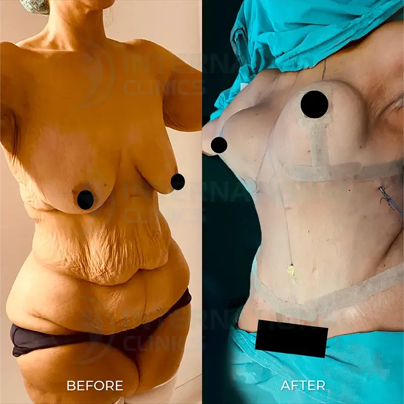 breast lift in turkey before and after3