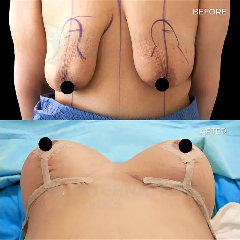 breast lift in turkey before and after2