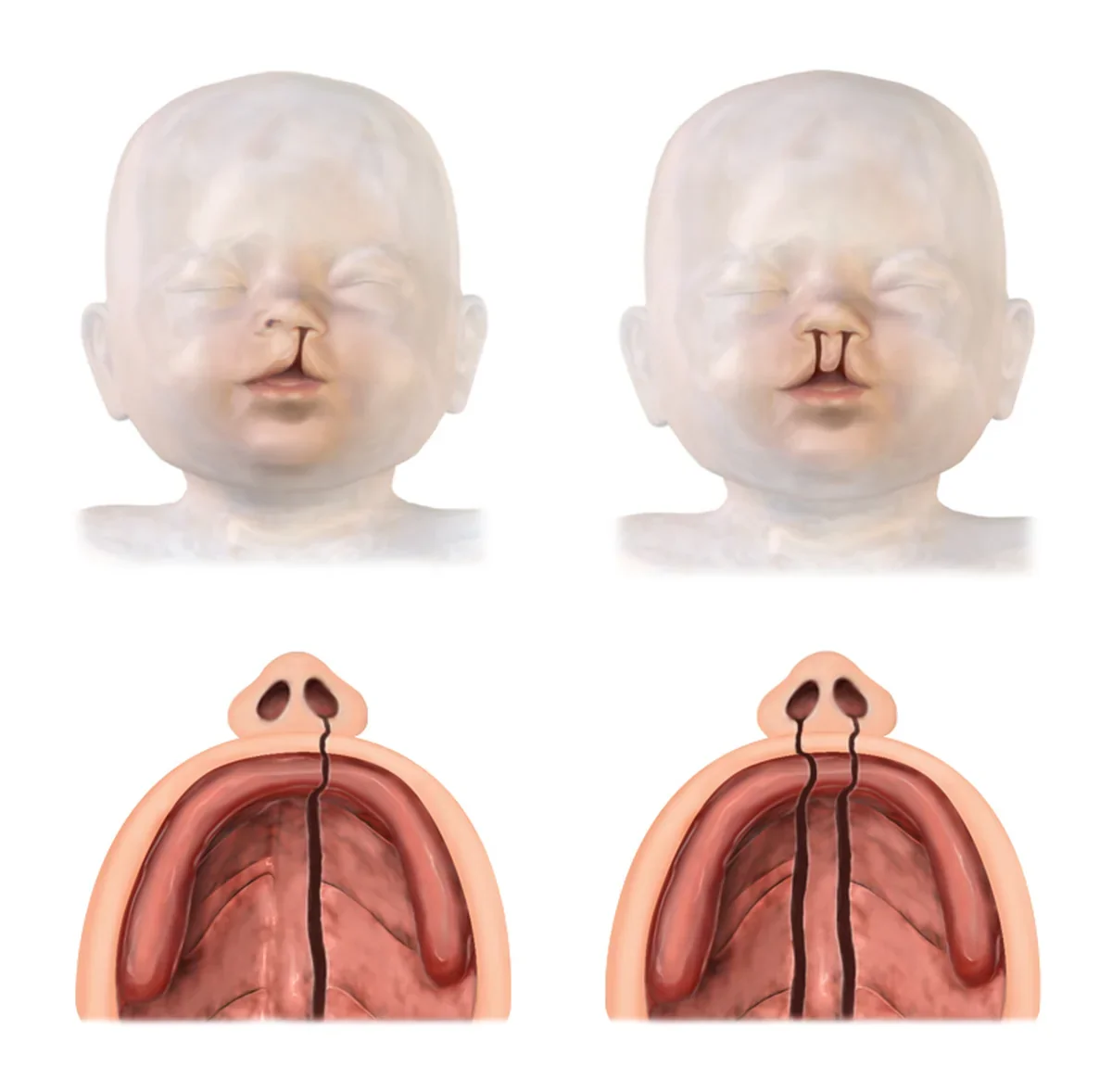Medical illustration of cleft lip and cleft palate types: unilateral and bilateral clefts of the lip and palate