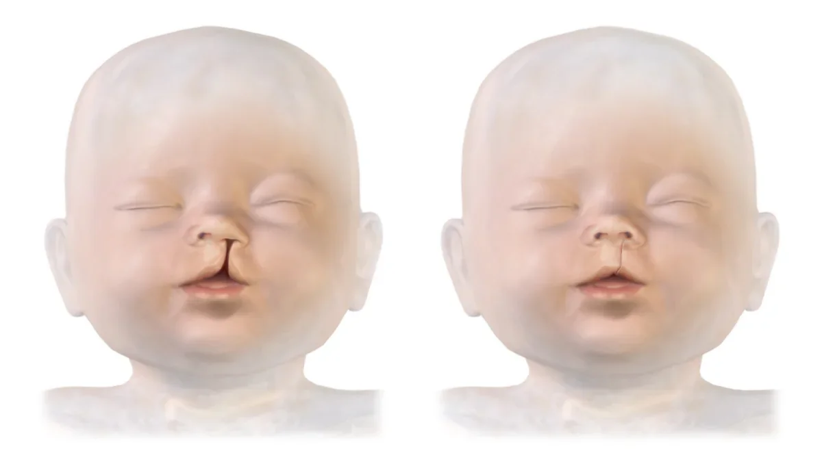 Illustration of a baby with a cleft lip before surgery and after cleft lip repair, leaving a thin scar