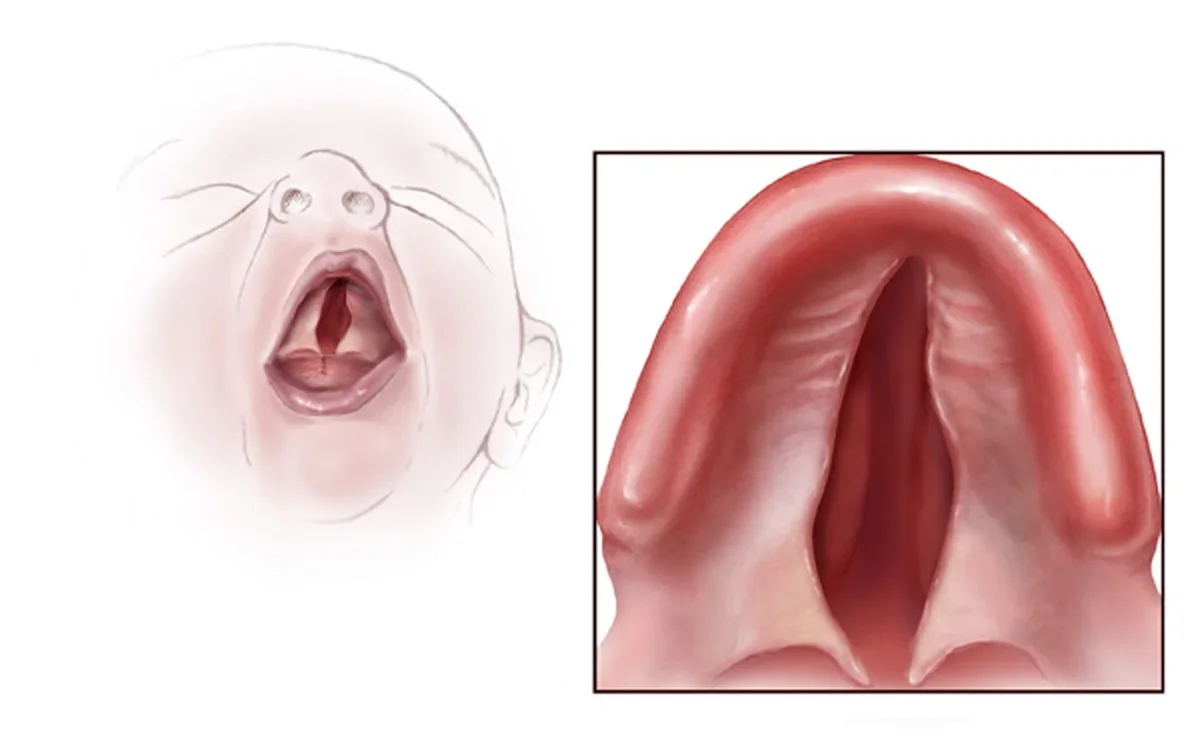 Medical illustration of a cleft palate in a baby: an opening in the roof of the mouth, with a close-up of the palate