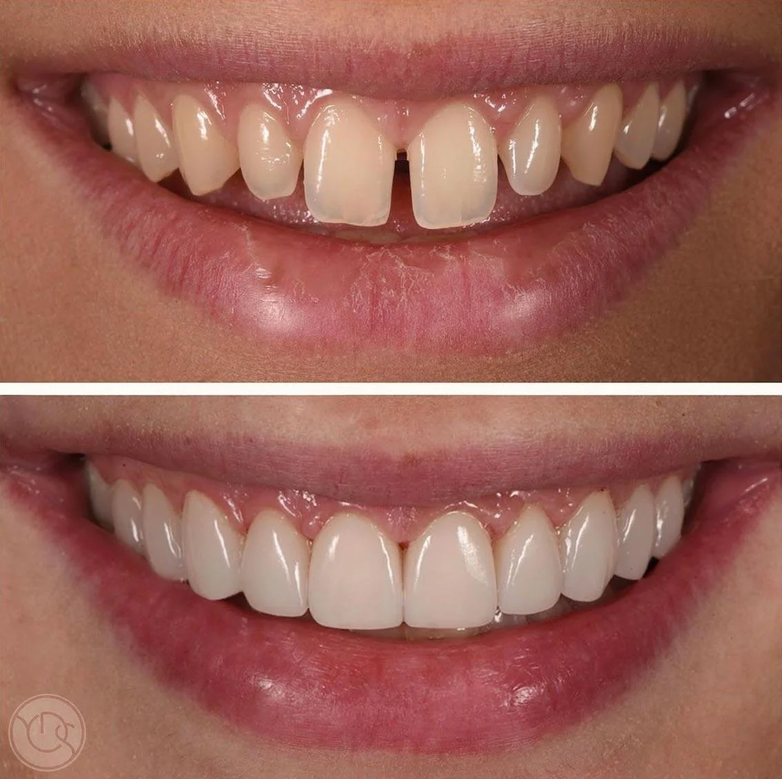Dental Veneers in Turkey Before and After