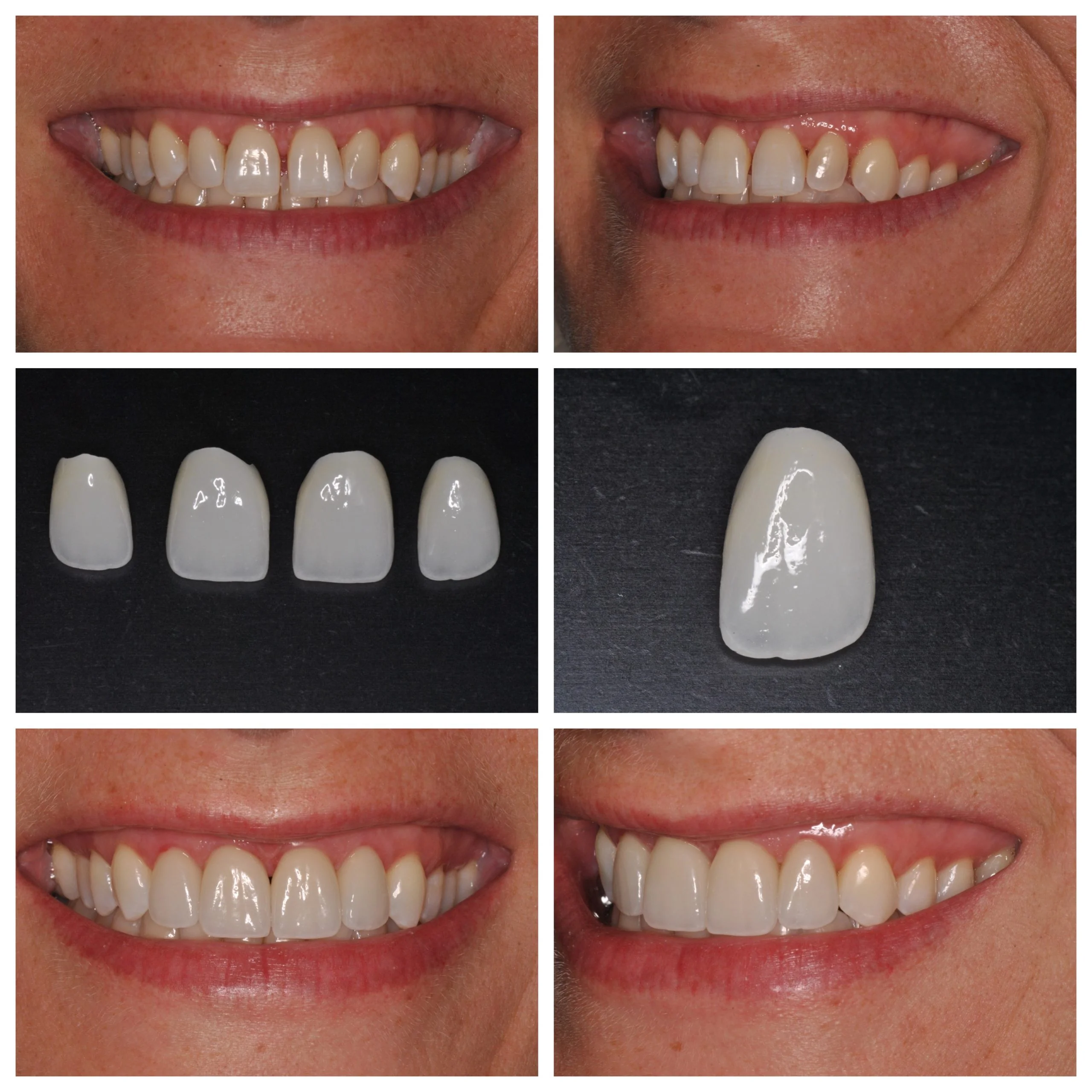 Dental Veneers in Turkey Before and After