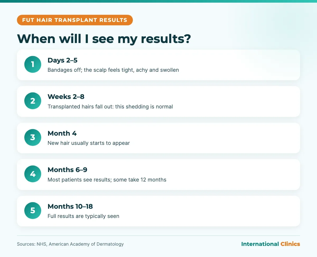 FUT hair transplant results timeline infographic: shedding at 2 to 8 weeks, new hair at 4 months, full results at 10 to 18 months