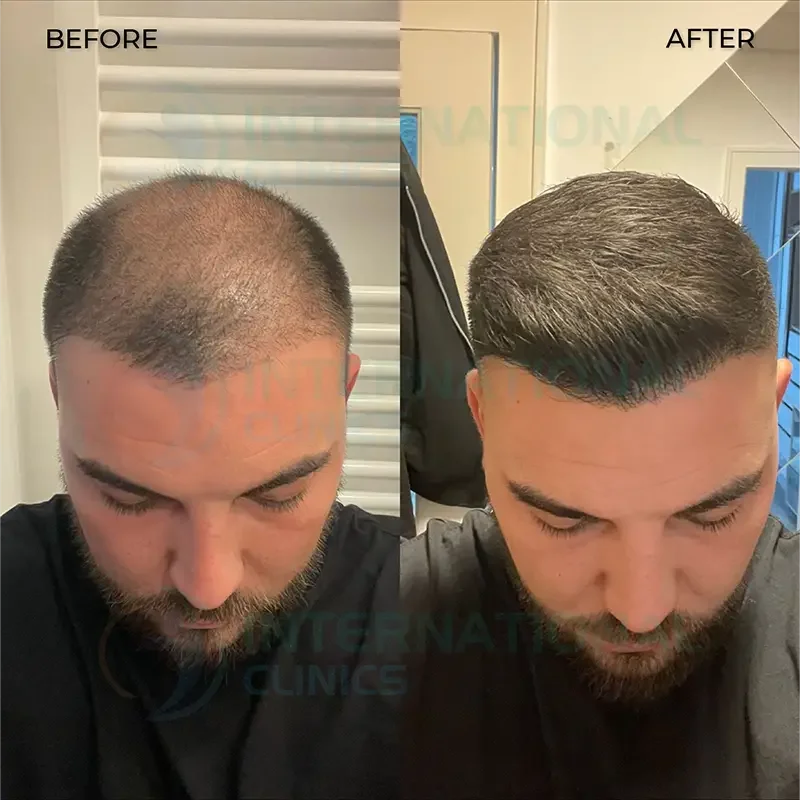 زراعة الشعر قبل وبعد  بالصور