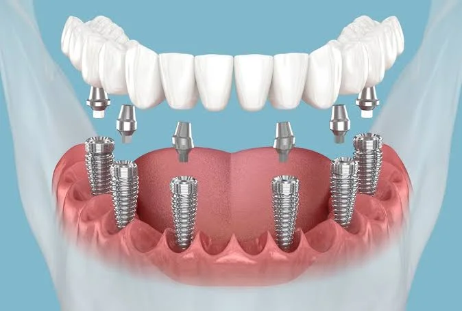باقة شاملة (Medigma Dental™ All on 6 – Zirconium)