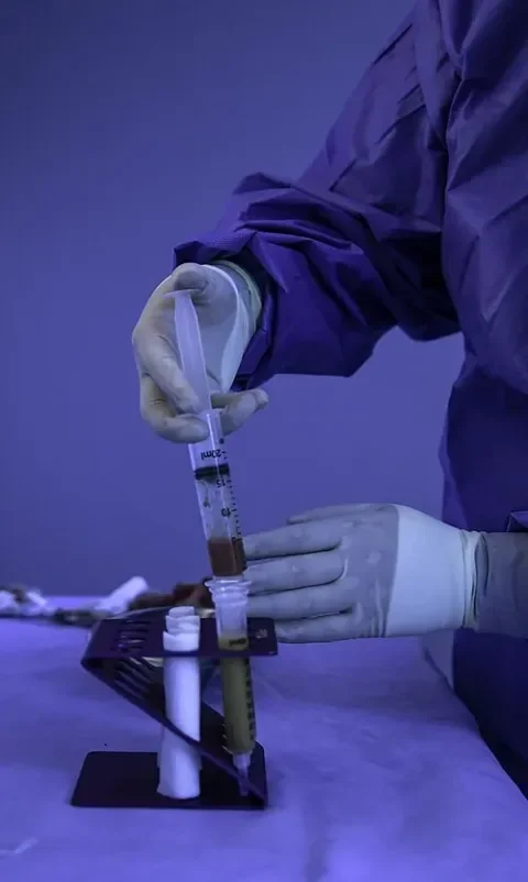 Préparation de la graisse en seringues, étape commune au lipofilling mammaire et aux autres transferts de graisse