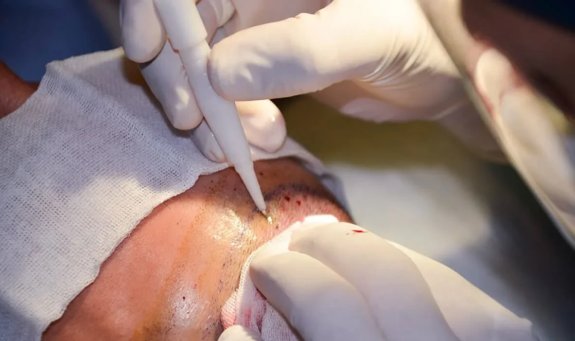 Surgeon using a DHI implanter pen to place grafts during a hair transplant procedure
