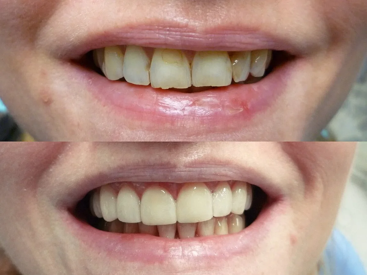 Close-up smile before and after porcelain veneers, showing worn yellow teeth replaced with even white veneers