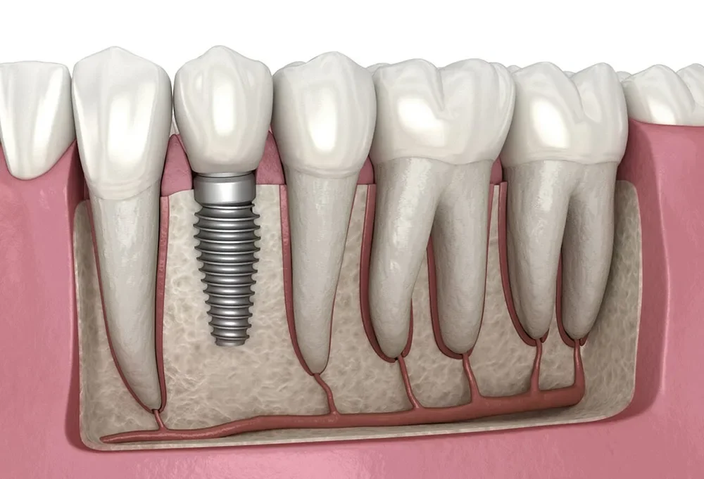 3D cross-section of a titanium dental implant and crown set in the jawbone