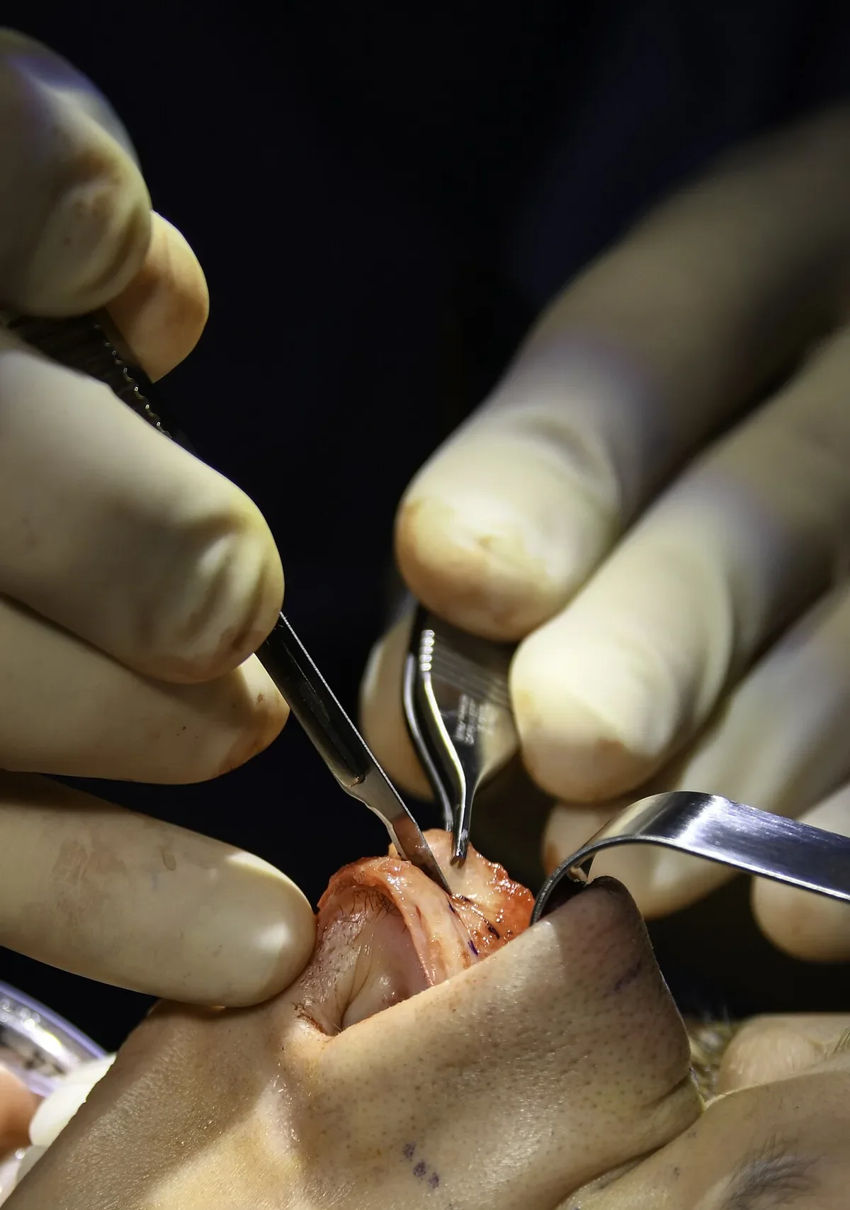 Surgeon reshaping nasal cartilage with fine instruments during an open rhinoplasty nose job operation