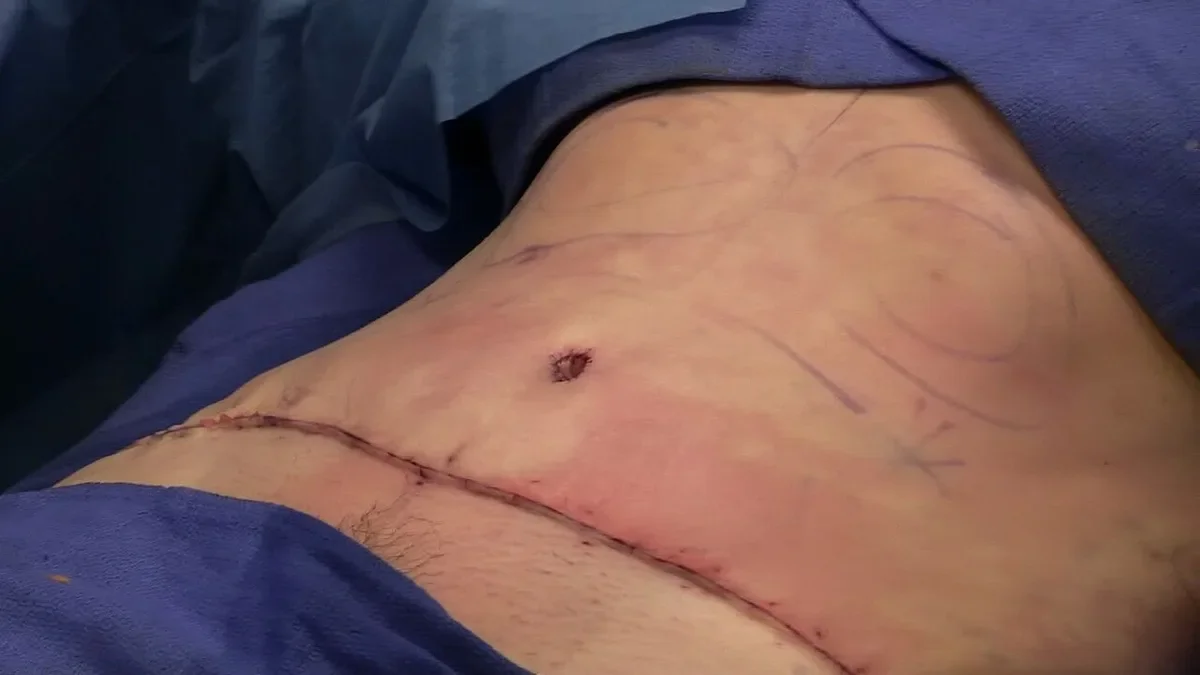 Fully sutured low abdominal incision after the tummy tuck stage of a mummy makeover